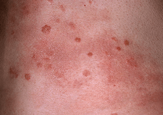 a pikkelysömör progresszív stádiuma