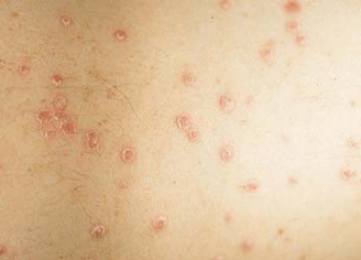 a psoriasis kezdeti szakasza