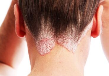 Psoriasis a fején
