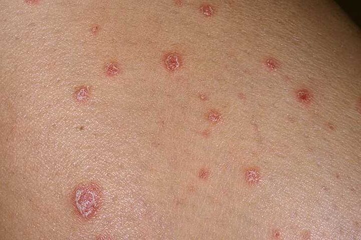 A psoriasis okai