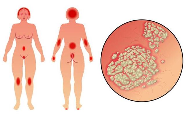 A psoriasis tünetei