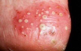 A psoriasis pustularis