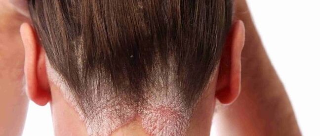 A fej psoriasis