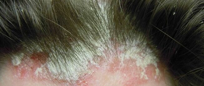 Psoriasis a fején