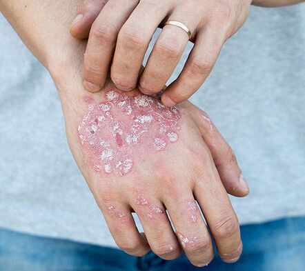 Psoriasis a karon
