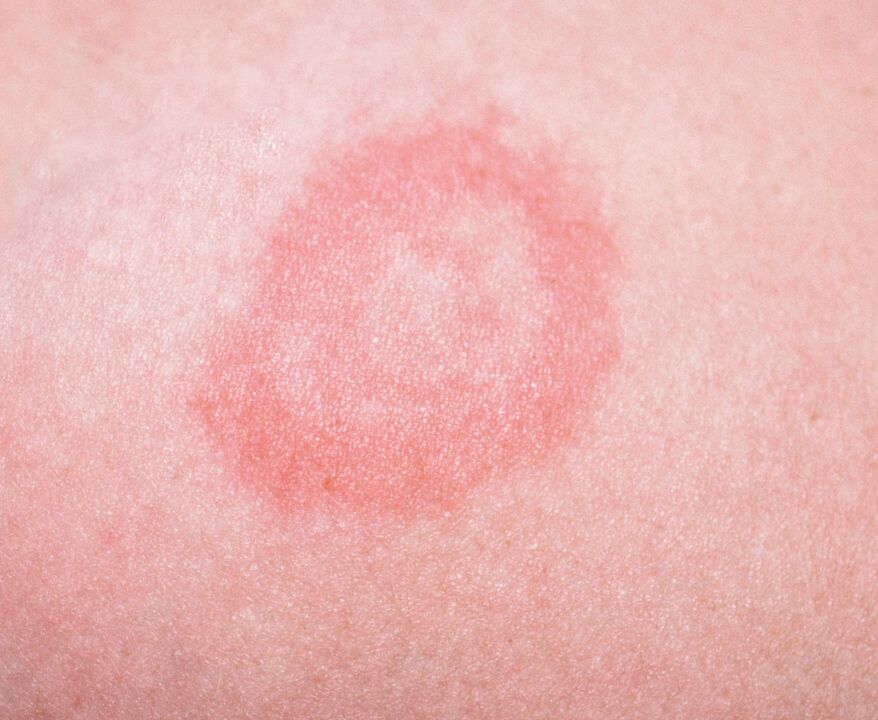 A psoriasis az