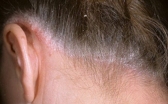 Psoriasis a hajban