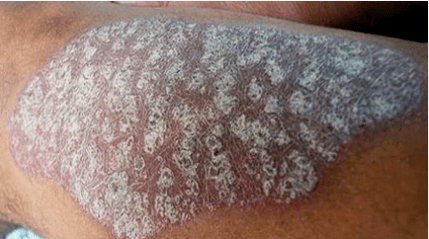 A psoriasis patogenezisének