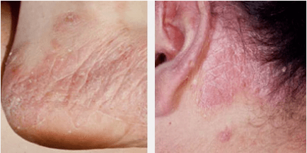 A psoriasis típusai