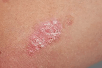 Psoriasis - Kezdeti szakasz