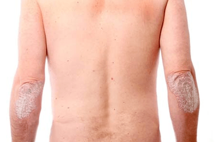 A psoriasis általános tünetei