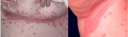Psoriasis atipikus formája
