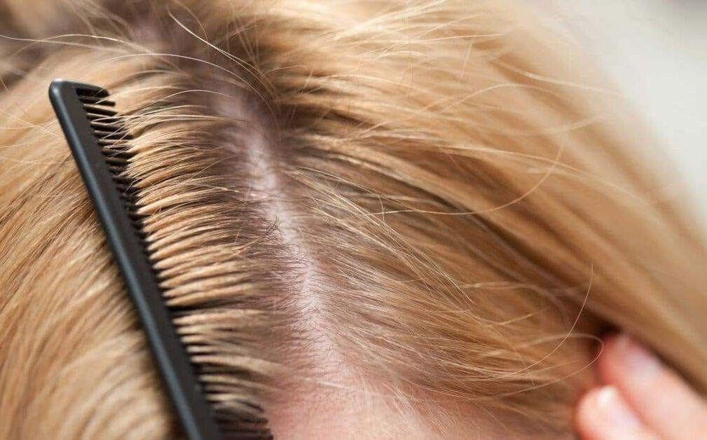 pikkelysömör típusa