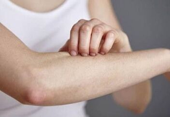 Psoriasis a kézen