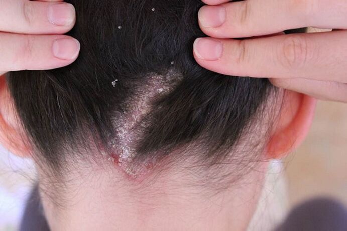 Psoriasis a fejen