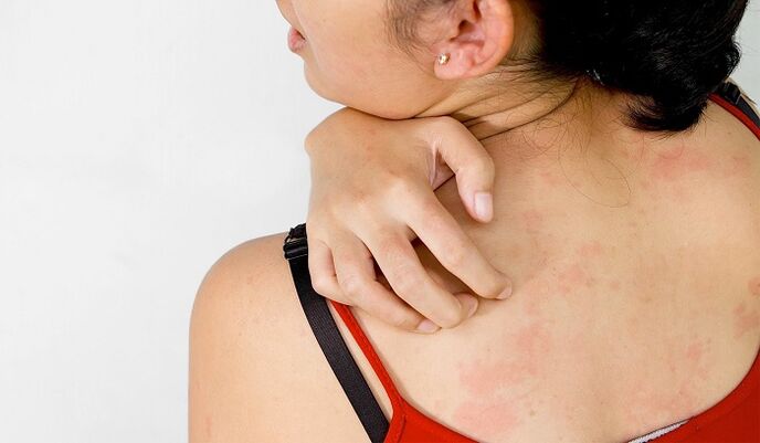 Psoriasis a háton