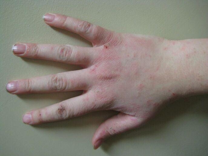 Psoriasis korai szakaszban