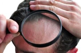 Psoriasis a fejen nagyítón keresztül