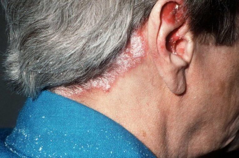 Psoriasis a fejen