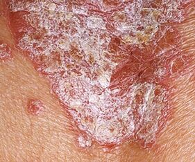 A psoriasis stacioner stádiuma