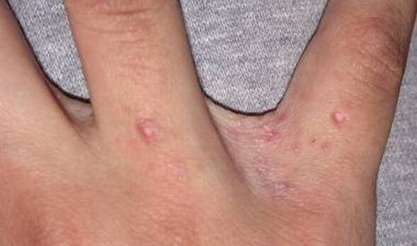 A psoriasis kezdete