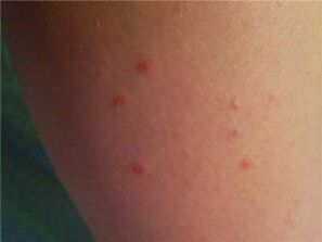 Psoriasis a bőrön