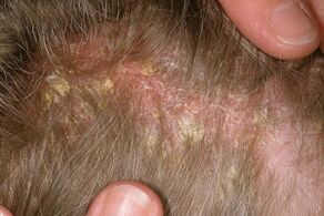 Psoriasis a fején