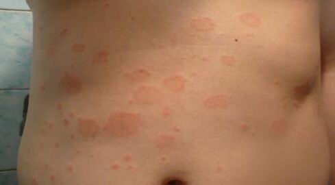 Psoriasis a testen